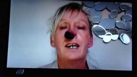 Embarrassing Bodies Big Black Lump On My Nose Youtube