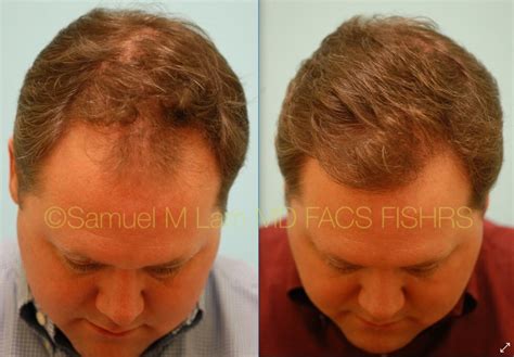 This Gentleman Is Shown Before And After One Session Of Hair Transplant