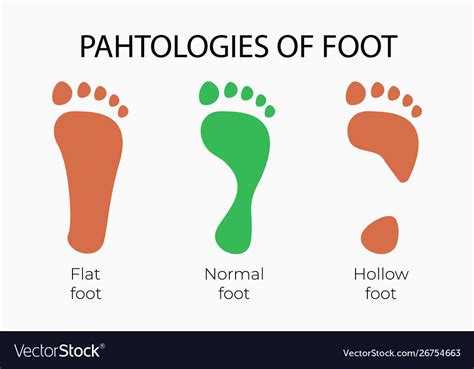 Flat Normal And Hollow Feet Royalty Free Vector Image