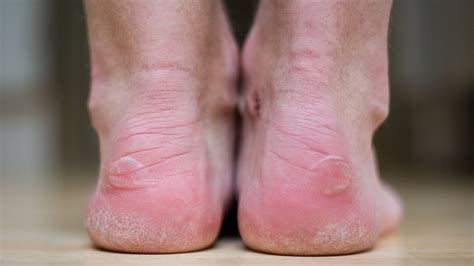 10 Common Foot Problems And How To Manage Them Everyday Health