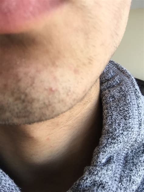 Red Marks On Chin But Arent Bumps Shaving