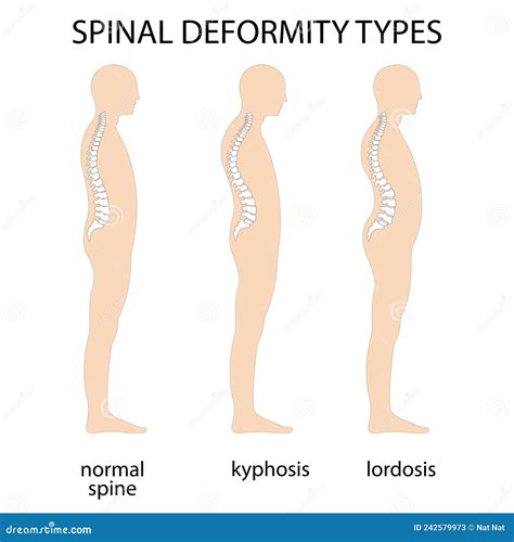 Spine Deformity Vector Illustration Kyphosis Lordosis Spine