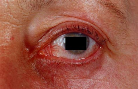 Facial Erythema And Eye Redness Aspergillus And Aspergillosis