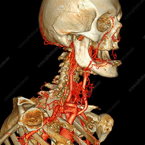 Neck And Head Arteries 3d Angio Ct Scan Stock Image C0096794