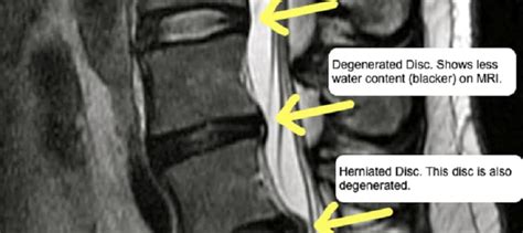 Degenerative Disc Disease Wake Spine Pain Specialists