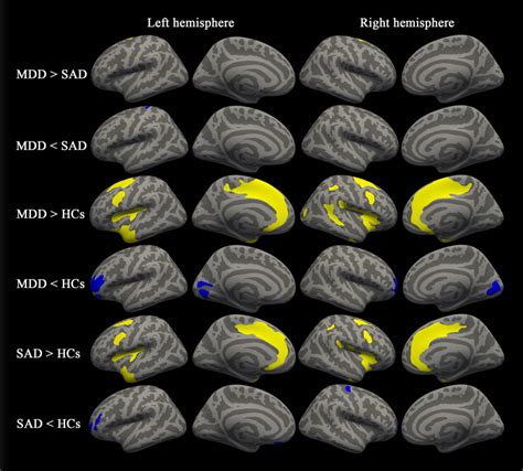 Mri Uncovers Brain Abnormalities In People With Depression And Anxiety