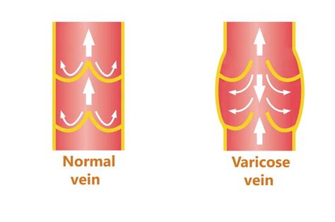 Learn About Varicose Veins During Pregnancy