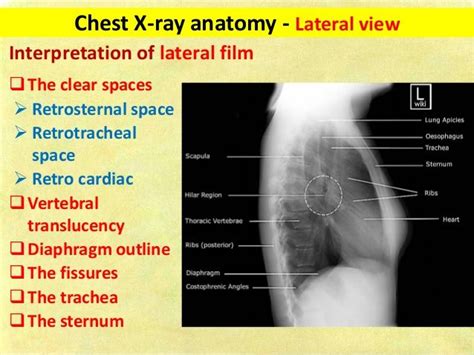 Chest X Ray Fundamentals With Images X Ray Chest Thoracic