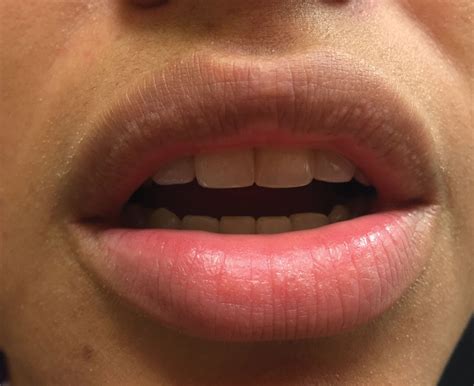 Small White Spots On The Lips Mdedge Dermatology