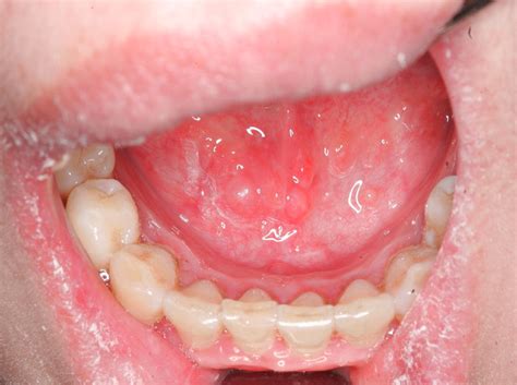 Multiple Superficial Mucoceles On Lower Lip Soft Palate Retromolar