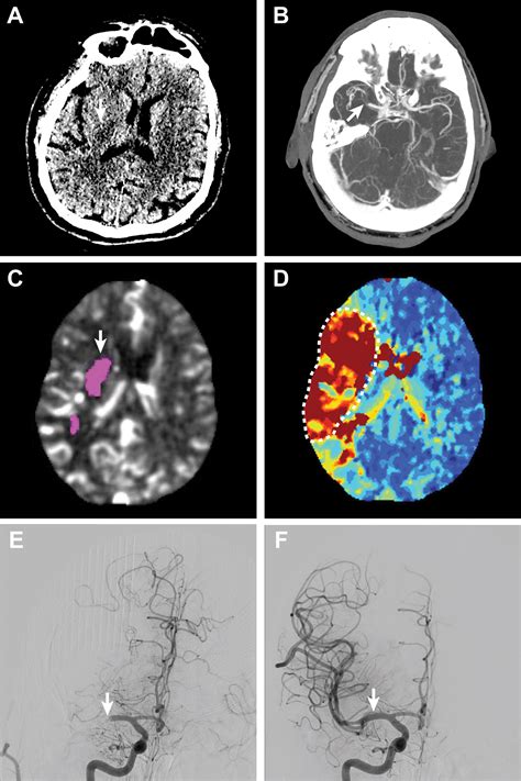 Acute Ischemic Stroke Treatment And Imaging Updates Arrs Inpractice