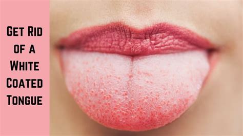 Natural Remedies To Get Rid Of A White Coated Tongue