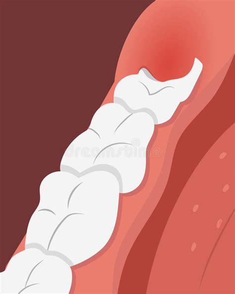 Illustration Of Teeth Row With Inflamed Gum Over The Growing Wisdom