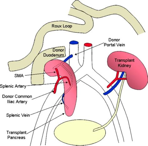 Pancreas Kidney Pancreas Transplant Procedure