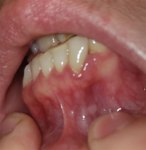 White Bumps On Gums