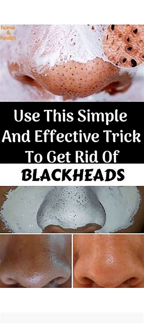 Simple And Effective Trick To Get Rid Of Blackheads In 2020 Natural