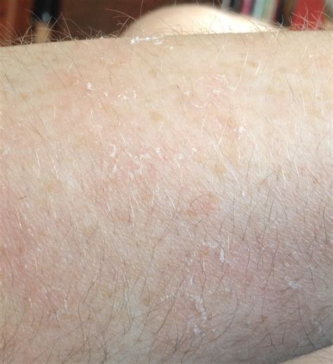 Small Round Patch Of Dry Skin On Arm Architectgala
