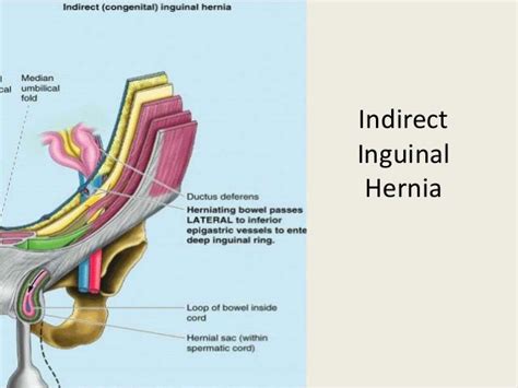 Tapp Inguinal Hernia Repair Anatomy Anatomy Structure