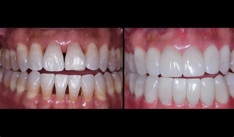 How Bioclear Empowers Dentists To Treat Black Triangles Optident