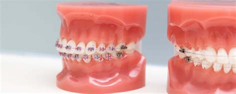 How Do I Know If I Need Braces Smile Team Orthodontics Blog