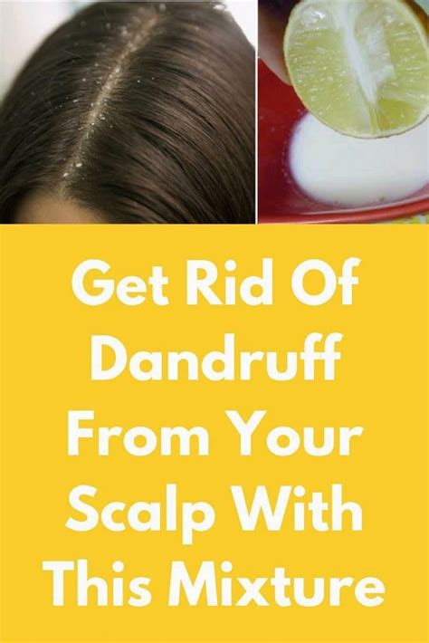 Get Rid Of Dandruff From Your Scalp With This Mixture Today I Will
