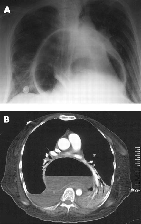 An Unusual Presentation Of Diaphragmatic Hernia Bmj Case Reports