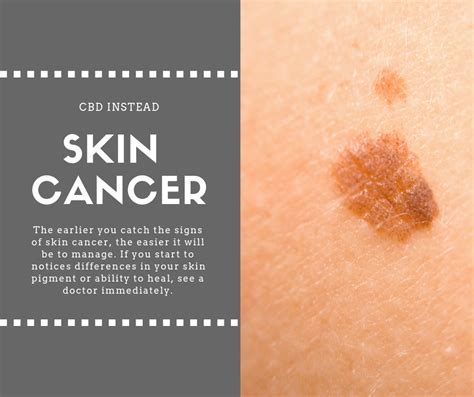 Signs Of Skin Cancer Skin Cancer Signs Come With Sun Coast Living Images And Photos Finder