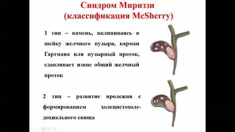 Диета при механическая желтуха Механическая желтуха - YouTube Механическая желтуха - YouTube Диета при механическая желтуха