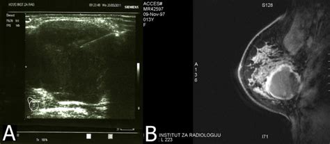Infarcted Fibroadenoma Of The Breast Report Of Two New Cases With