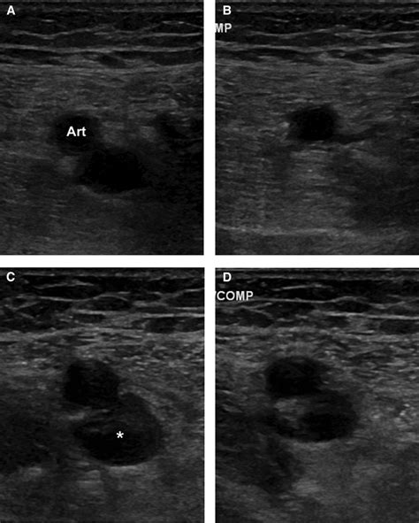 Ultrasound For Lower Extremity Deep Venous Thrombosis Circulation