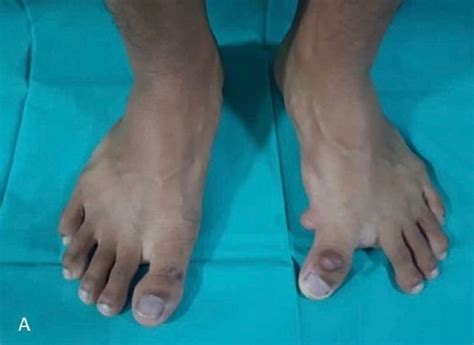 Cureus Congenital Hallux Varus A Rare Forefoot Deformity