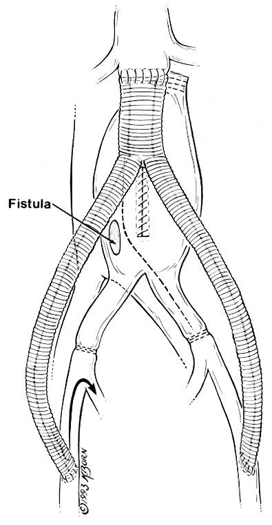 Aortocaval Fistula Treated By Aortic Exclusion Journal Of Vascular