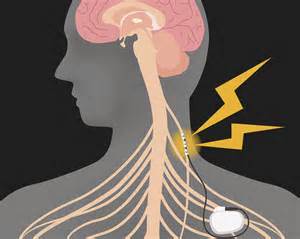 Noninvasive Vagus Nerve Stimulation May Improve Parkinson Disease