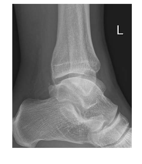The achilles tendon is a strong fibrous cord that links the muscles in the back of your calf to your heel bone. Imaging Case of the Week 254 | Emergucate