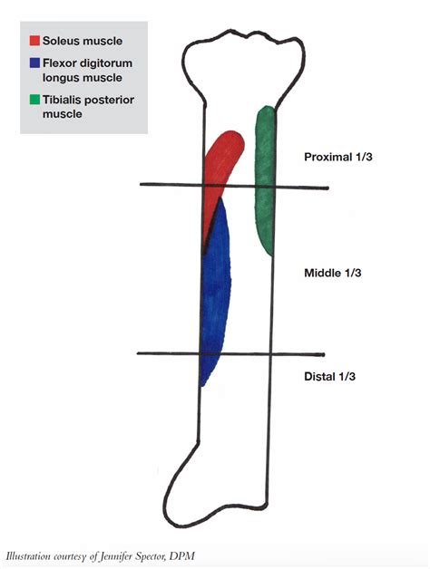 Exploring The Mystery Of Medial Tibial Stress Syndrome