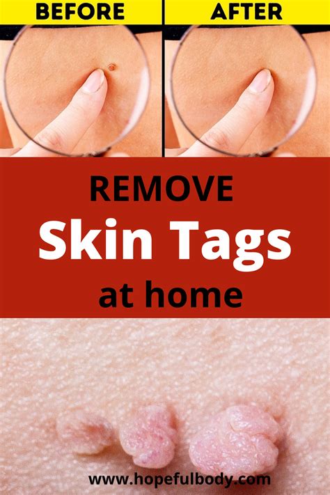 how to get rid skin tag overnight skin tag removal skin tag cold home remedies