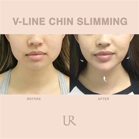 V Line Face Slimming Using Botox Asian Cosmetic Surgery Usha