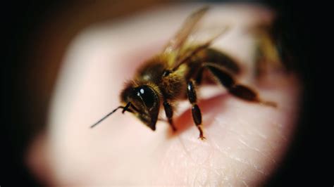 How To Treat A Bee Sting At Home And When To Head To The Hospital