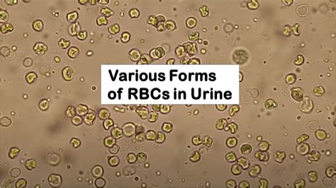 Various Forms Of Rbcs In Urine Microscopy I Hematuria Youtube