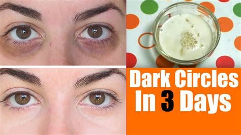 Home Remedies For Dark Circle Under Eyes Top 5 Diy