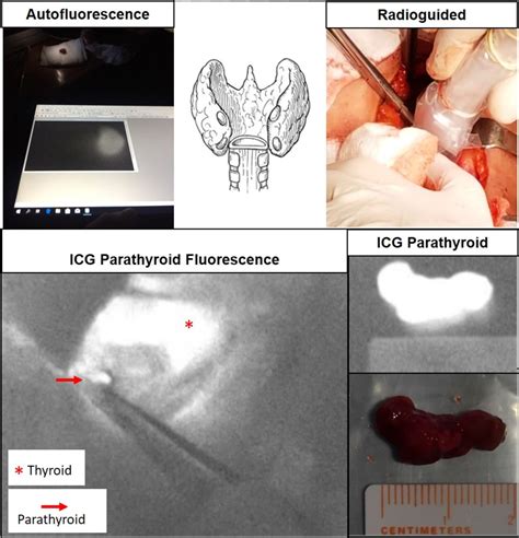 Radioguided And Fluorescence Options For Intraoperative Parathyroid