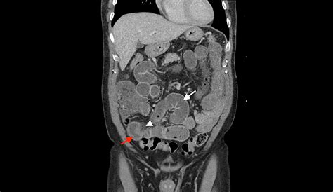 Cureus A Rare Case Of Small Bowel Obstruction Due To Sunflower Seeds