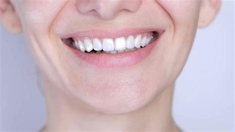 Perfect White Teeth Close Up Female Veneer Smile Dental Care And