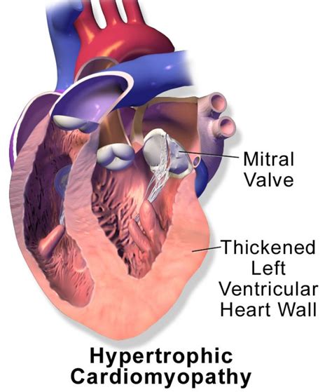 Biobanking Science Hypertrophic Cardiomyopathy