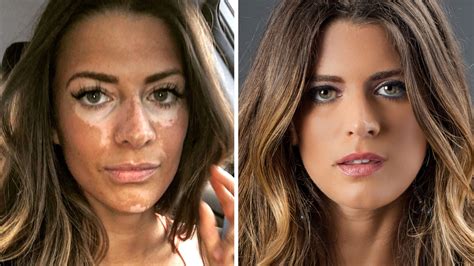 Model Embraces Rare Skin Condition In Powerful Post Today