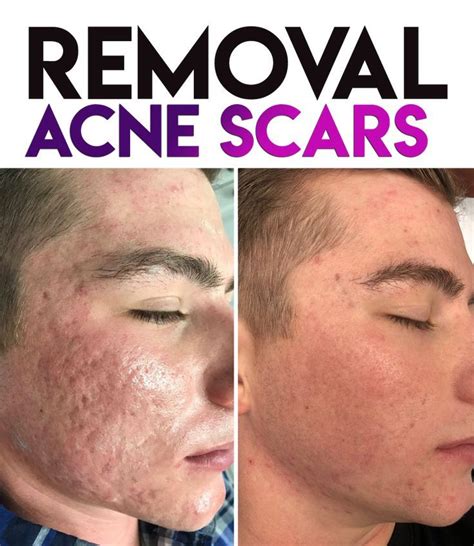 Back Acne Scars Laser Treatment Cost Wererabbits