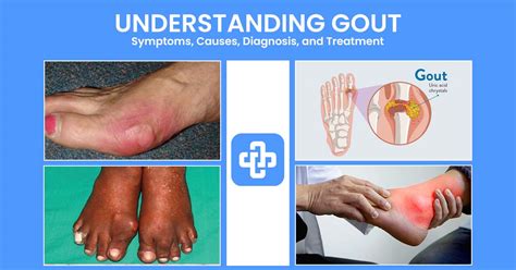 Understanding Gout Symptoms Causes Diagnosis And Treatment Manage