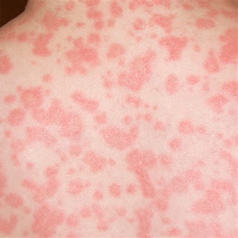 They can also be mistaken for other skin conditions. How Long Does A Food Allergy Rash Last - Food Ideas