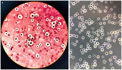 Cryptococcus Neoformans An Overview