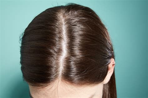 My Hair Is Thinning Reasons For Hair Loss Explained